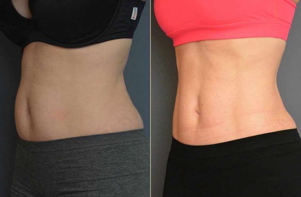 25% off all CoolSculpting Treatments this May!