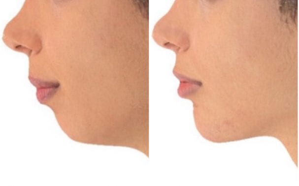 Why Juvederm Volux Is The Best Product For Jawline Contouring (2019)