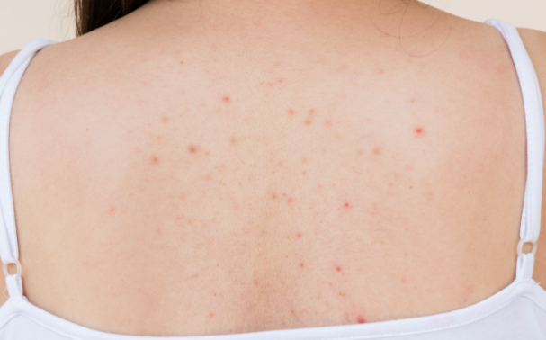 7 ways to combat back acne