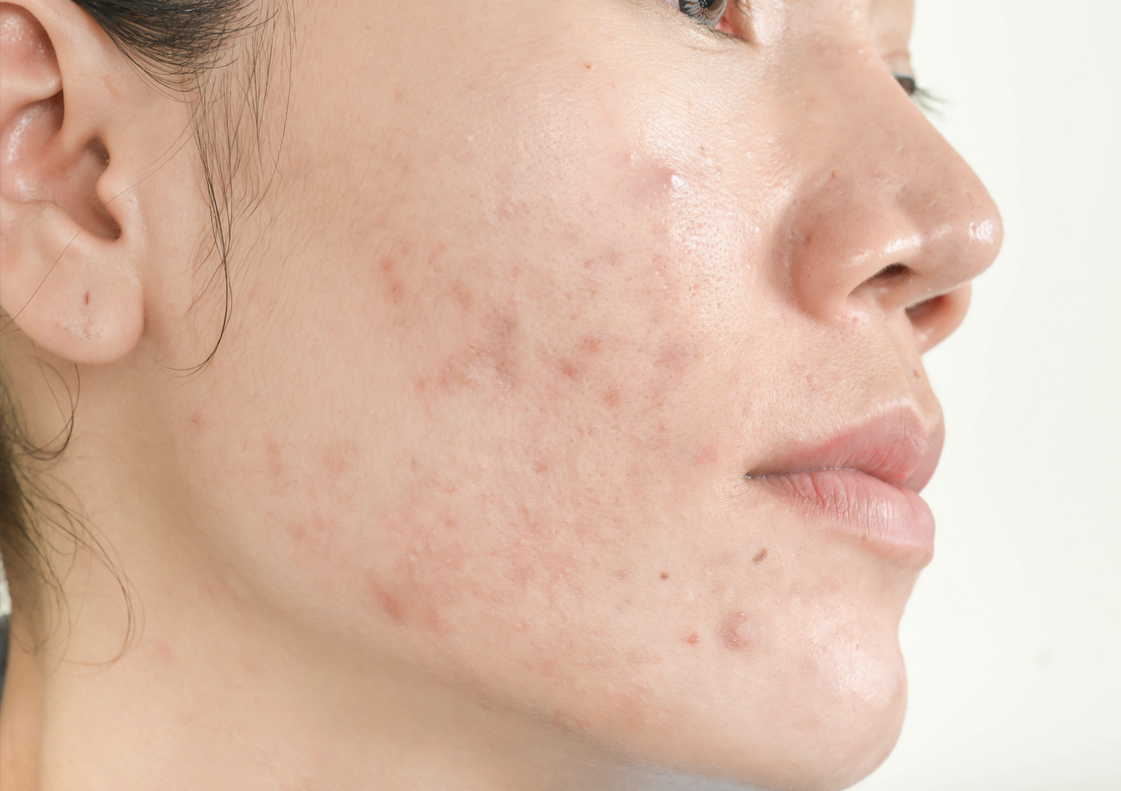 When Should You Seek the Help of a Professional for Your Acne?