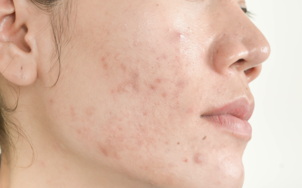 How to get rid of an acne breakout quickly
