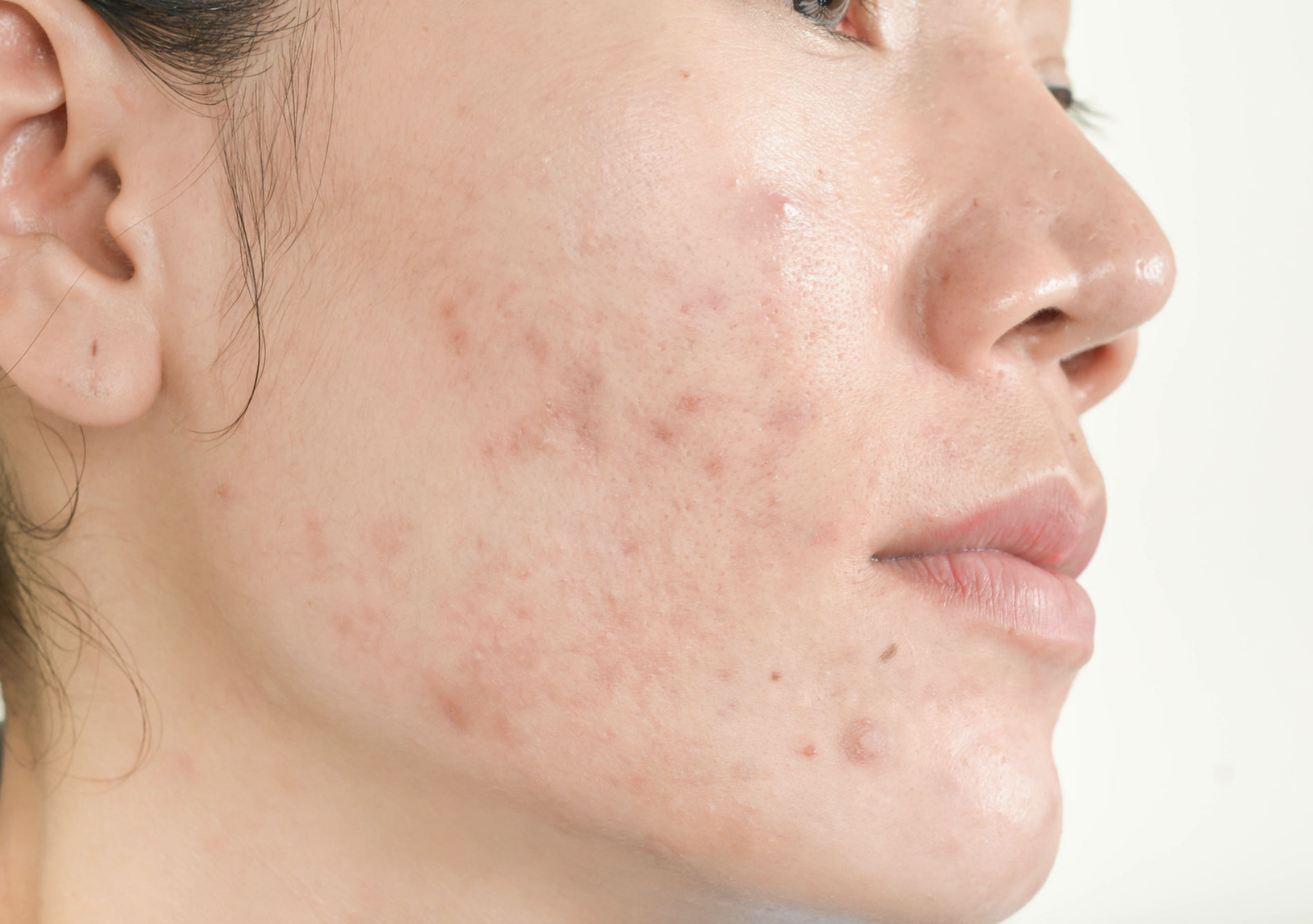 How to get rid of an acne breakout quickly