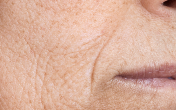 Can deep wrinkles be treated as easily as fine lines? The best treatments