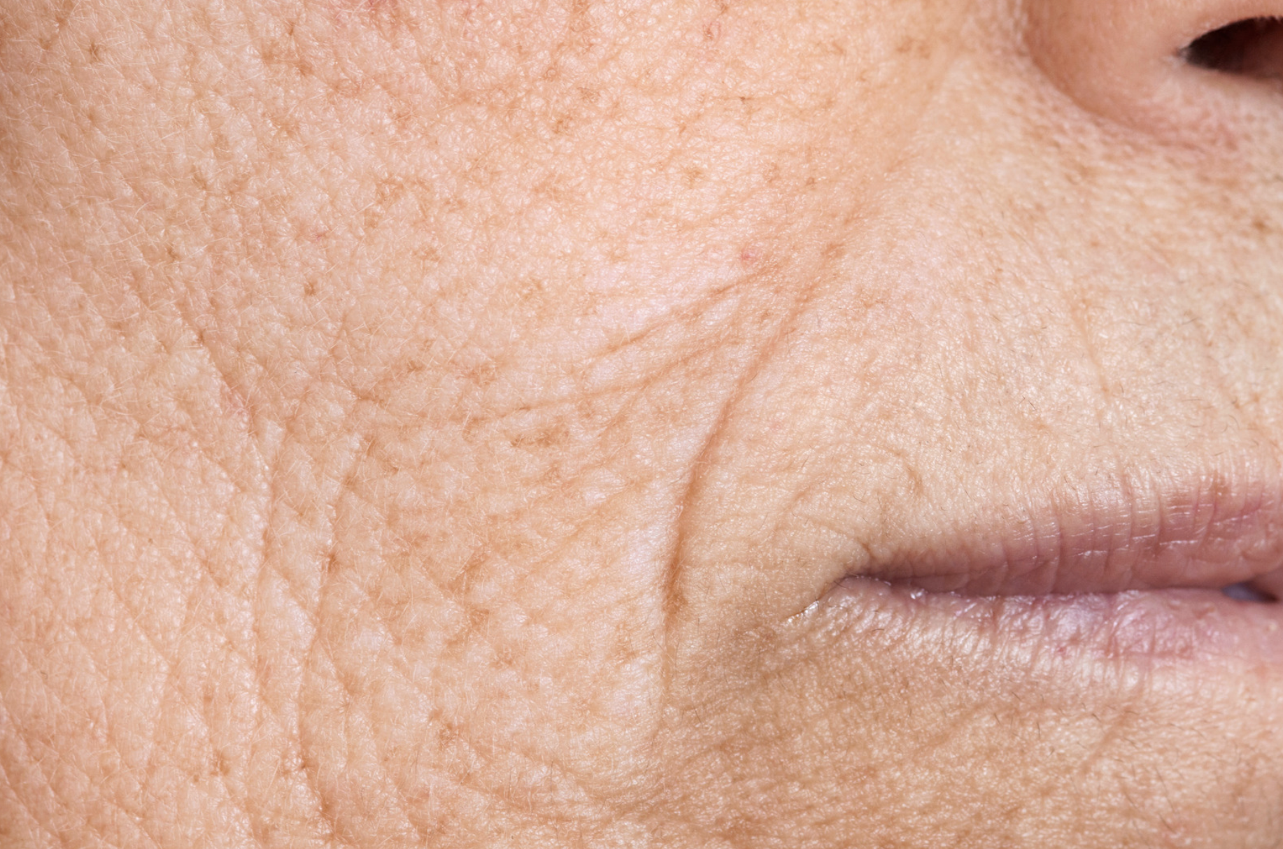 Can deep wrinkles be treated as easily as fine lines? The best treatments