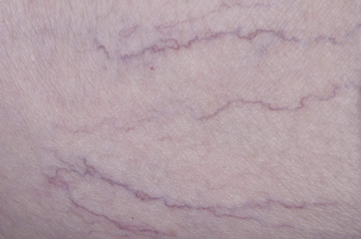Thread (spider) veins vs. Varicose veins – what’s the difference?