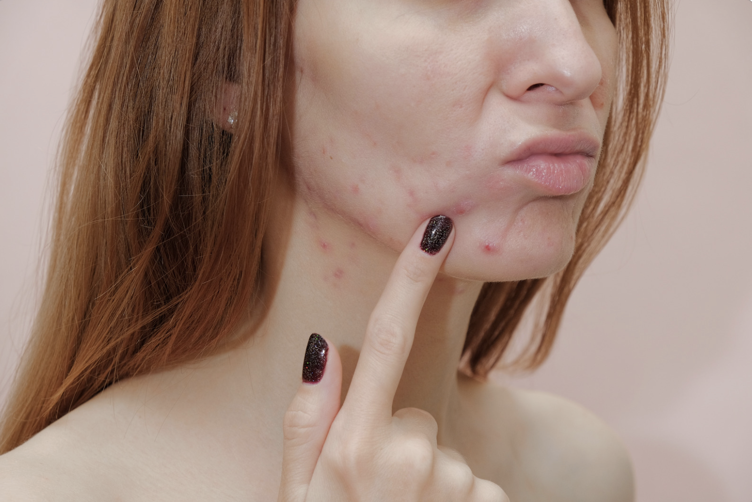 What causes pregnancy acne and how can you treat it?