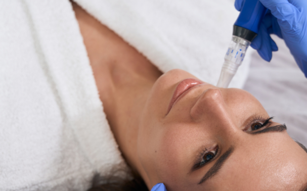 Can Microneedling Cause Acne?