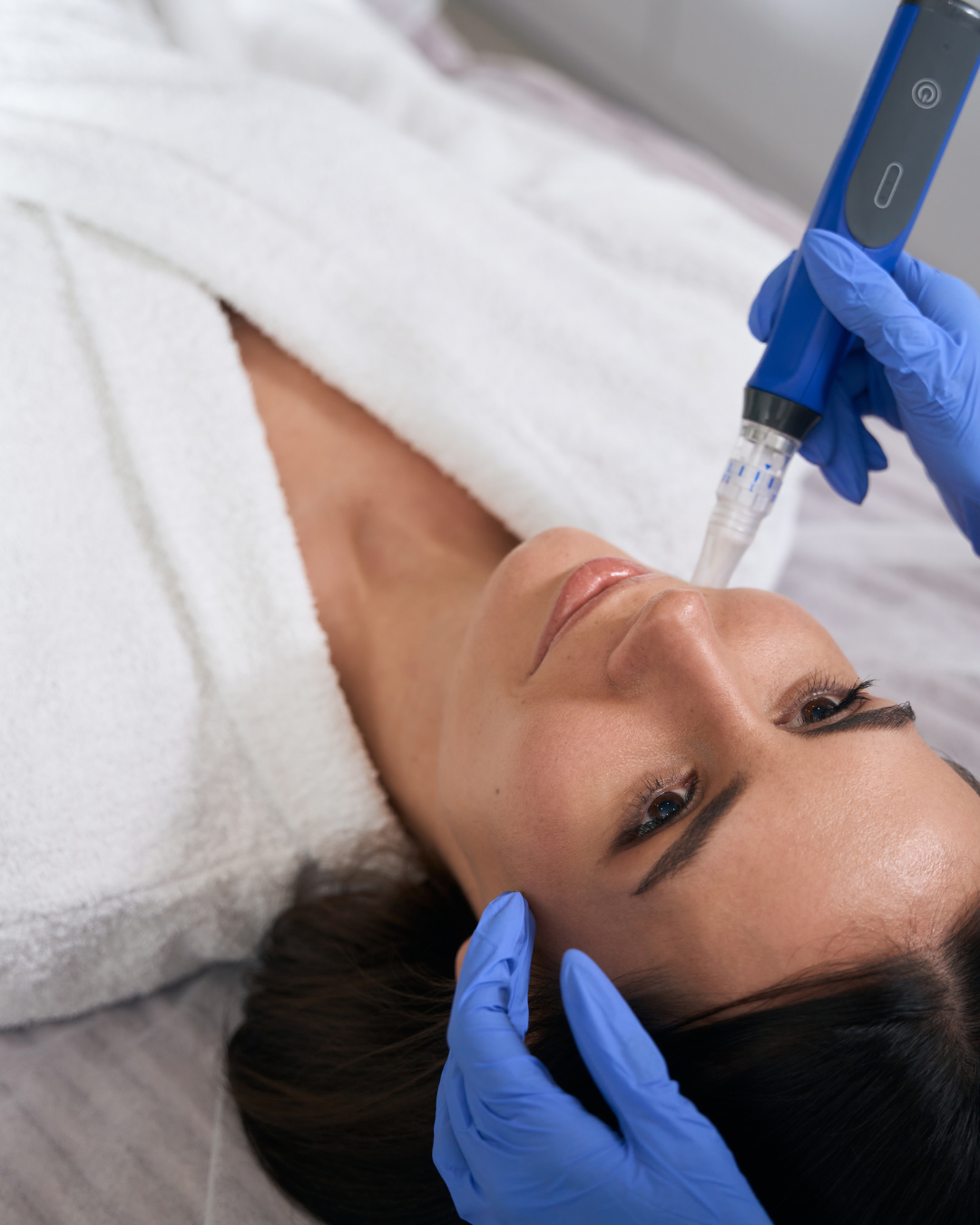 Can Microneedling Cause Acne?